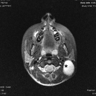 şişlik nedeni ile kliniğimize başvurdu. US de boyun sağ yanında 45x56x72 mm boyutlarında yoğun içerikli komplike kist olduğu rapor edildi. MRG de kitlenin, n. accessorius, n. hypoglossus, v.