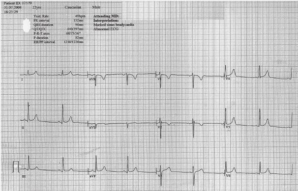 Solda: EKG de inferior derivasyonlarda erken repolarizasyonla uyumlu