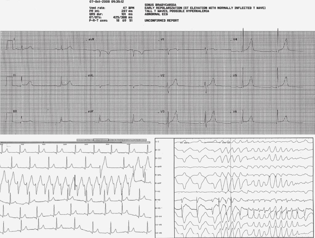 122 Türk Aritmi, Pacemaker ve Elektrofizyoloji Dergisi ŞEKİL 3 Üstte: Bazal EKG de inferolateral derivasyonlarda erken repolarizasyon gösterilmektedir.