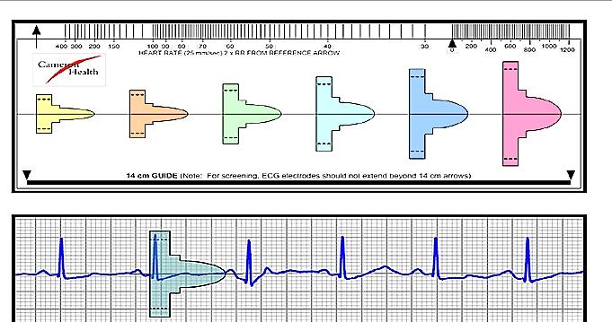 S-ICD için Uygunluk Testi ( Screening Tool ) Yüzey EKG kullanılarak S-ICD