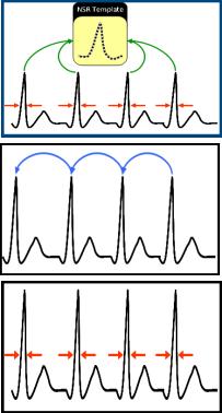 morfolojik olarak yüzey EKG sine benzeyen yüksek çözünürlüklü sinyal Oversensing i