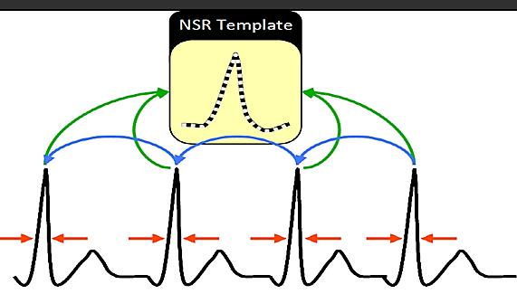 S-ICD Ritm Diskriminasyonu S-EKG nin doğru tanınması ve sınıflandrılması için 3