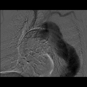 sagital reformat BTanjiografi imajında ve (b) stent