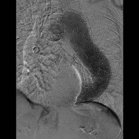 ikinici stent greft yerleştirilmesi sonrası elde olunan