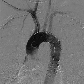 (b) Stent greft yerleştirilmesi sonrası elde olunan anjiografi görüntüsünde