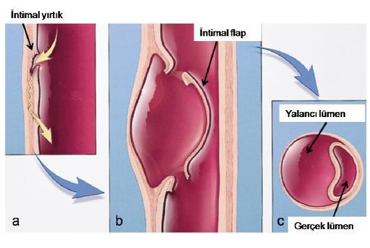 Şekil 8: Aort disseksiyonunun şematik gösterimi: İntima tabakasındaki giriş ve çıkış yırtıklarının sonucunda oluşan intimal flep, gerçek ve yalancı lümenler. 2.2.2.1.3.