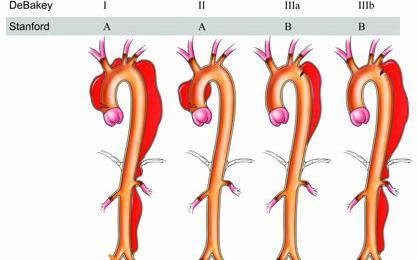 Stanford sisteminde disseksiyonlar ikiye ayrılır: Tip A disseksiyonlar inen aortun etkilenip etkilenmemesine bakılmaksızın çıkan aort ve arkus aortu kapsayan disseksiyonlardır.