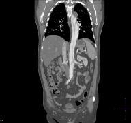 OLGU: 55 Y, E, STENT GREFT 1 a b c Resim 4: Acil servise sırt ve sağ bacak ağrısı