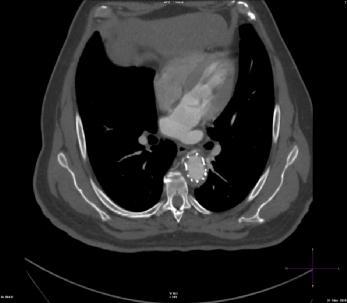 (b) Koronal reformat görüntüde sol renal arter ve sağ ana iliak arterdeki