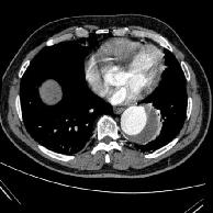 5. OLGU: 70 Y, E, STENT GREFT 1 a b c Resim 14: Bilinen abdominal aort