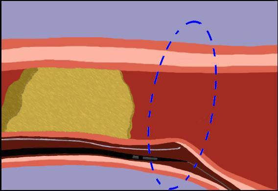 IVUS Guided Technique