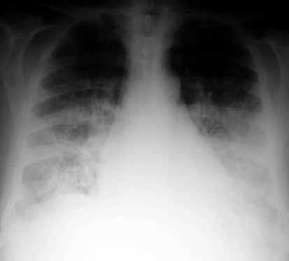 Pulmoner ödem (hidrostatik ve geçirgenlik), erişkin respiratuvar distres sendromu (RDS), pulmoner hemoraji sendromları, aspirasyon, inhalasyonal hastalıklar, eozinofilik hastalıklar ve yaygın