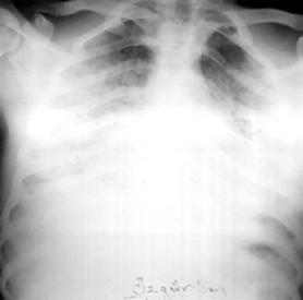 86 Özkan R. C radyografiler tipik olarak normaldir. Semptomların gelişiminden sonraki ilk 24 saat içerisinde radyografiler anormal hale gelir.