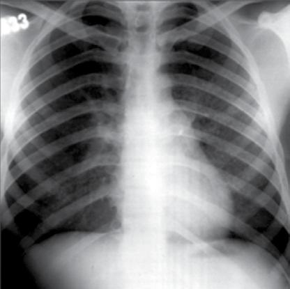 Kronik konsolidasyon (4-6 hafta); çok az değişikliklerle birlikte ise eozinofilik pnömoni, organize pnömoni, adenokarsinoma (bronkoalveolar karsinoma), lenfoma, lipoid pnömoniyi akla getirir.