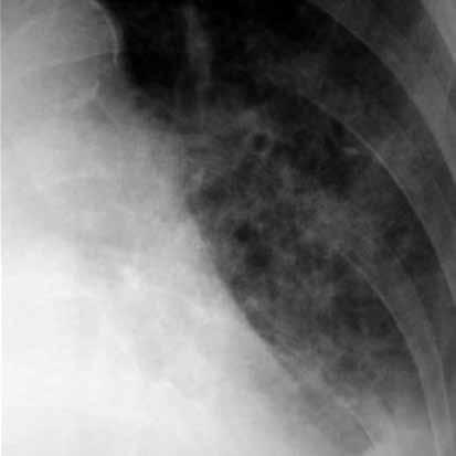 Pulmoner fibrozisde bazen belirgin Kerley çizgileri görülebilir. ncak retiküler örnek daha tipiktir. En sık sarkoidozda izlenir [19].