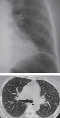 90 Özkan R. C Pulmoner fibrozis ve bal peteği gelişen akciğerde orta örnek tipiktir. Retiküler değişiklikler sıklıkla periferal, arka ve alt lob ağırlıklı yerleşim gösterirler.