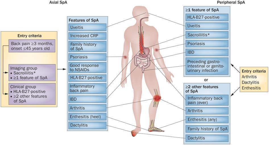 ASAS axial ve periferik SPA sınıflama kriterleri Daha çok kadında Aksiyel SPA hastalarının 3 te birinde MRI normal ya da ASAS/OMERACT