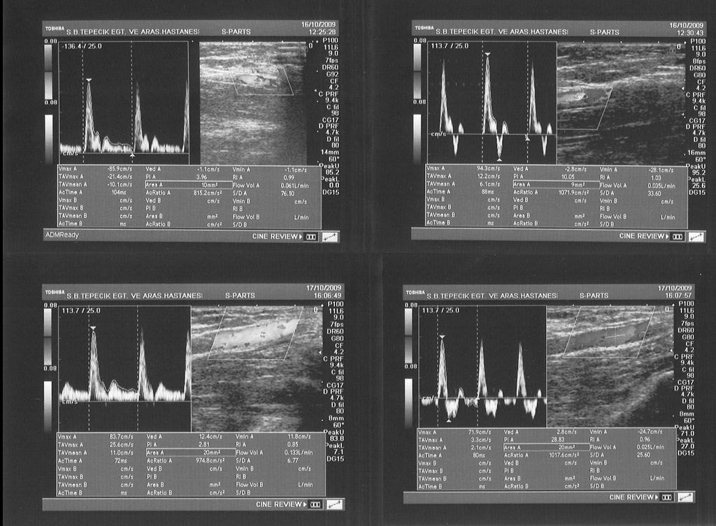 108 Tepecik Eğit Hast Derg 2010; 20 (3) Şekil 1. İki olguya ait darlık öncesi akımda aygıt üzerindeki yazılımın ürettiği spektral Doppler bulguları izleniyor.