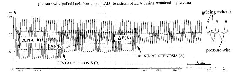 Diffuz hastalık Hangi lezyonun iskemiden sorumlu olduğunun tespiti için pulback yapılmalı Bu esnda Adenozin iv infüzyonu veya ic papaverin P(A+B)= hem distal hem de proskimal lezyonun birlikte