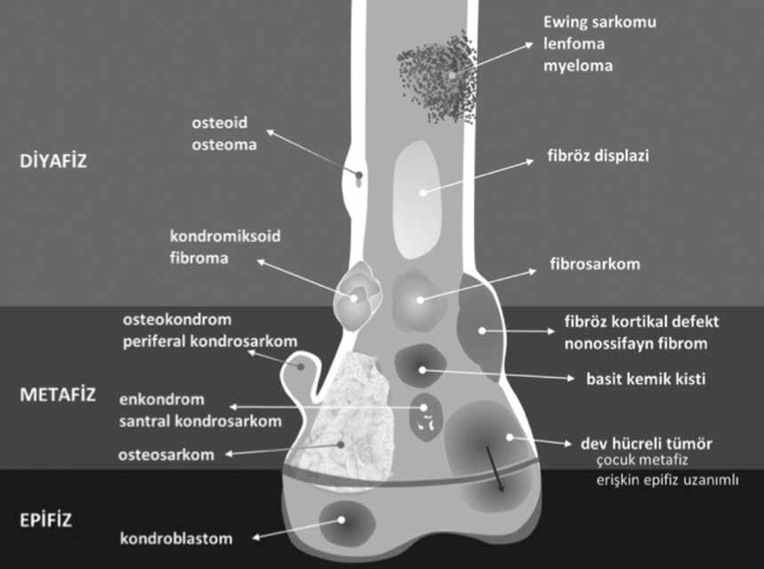 Kemik ve Yumuşak Doku Tümörlerinin Değerlendirilmesinde Temel Radyografik İlkeler 57 Subakut osteomyelit olgularının yaklaşık yarısında tümör ile karışmaktadır. Kemik tümörleri genellikle soliterdir.