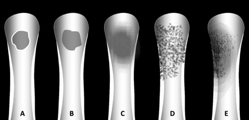 Kemik ve Yumuşak Doku Tümörlerinin Değerlendirilmesinde Temel Radyografik İlkeler 59 Resim 2. A-E.