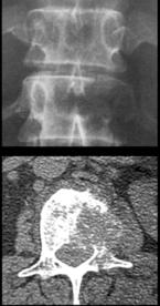 64 Kaya T. A B C değerlendirmede, kemik tümörlerinde olduğu gibi görüntüleme bulgularının da birlikte göz önünde bulundurulması gereklidir.
