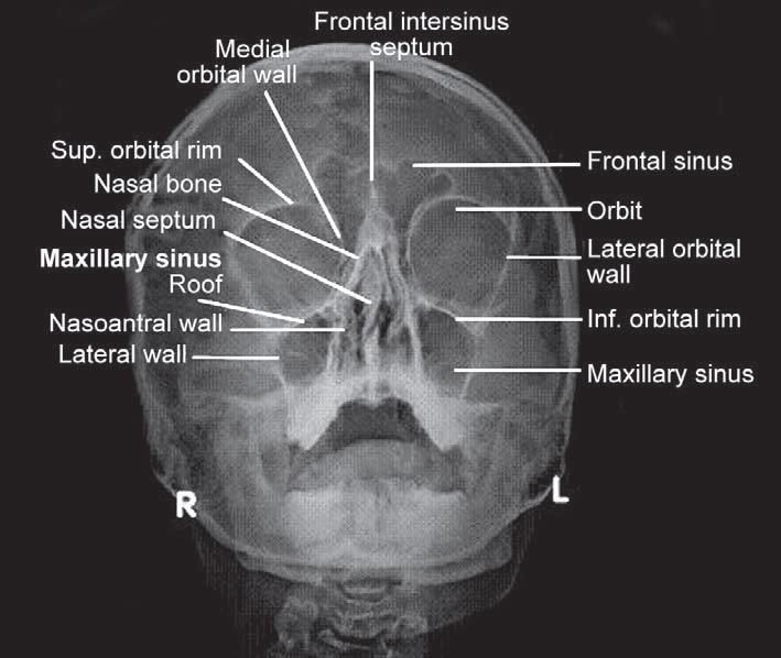 Maksiller sinüs Frontal ve sfenoid sinüs Zigoma, arkus zigoma Nazal kemikler,