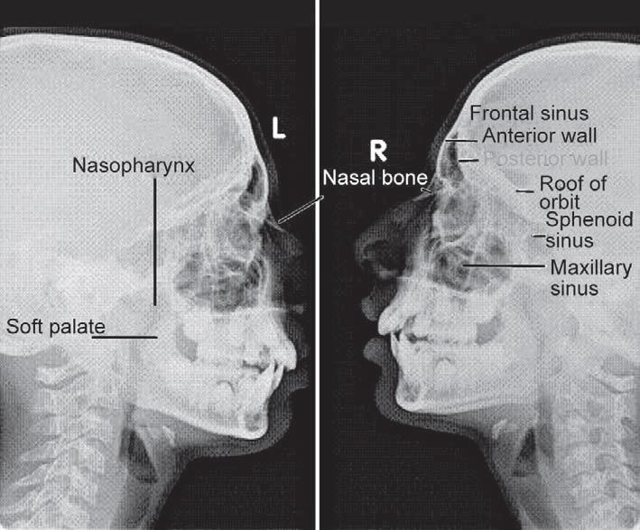 Lateral Nazal Grafi Fraktür hattı, deplase veya eleve kırık