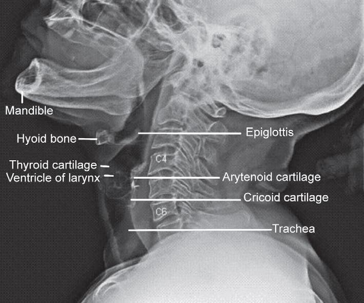 Lateral Boyun Grafisi Dil kökü, vallekula Hiyoid, epiglot, ariepiglottik fold, aritenoidler Kord vokal, ventrikül Tiroid ve