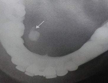 Oklüzal Submandibular