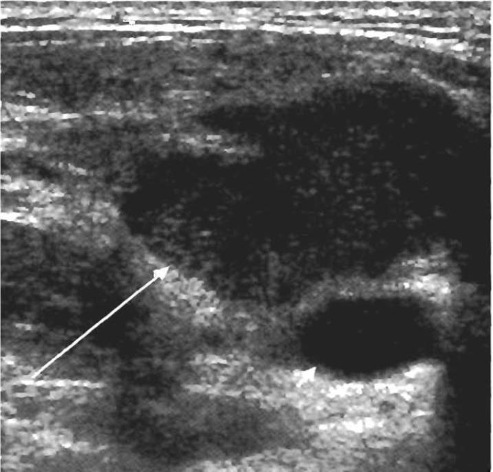 Lenfadenopati & USG Normal lenf nodları küçük ve çevre dokularla benzer ekojenite gösterdiğinden