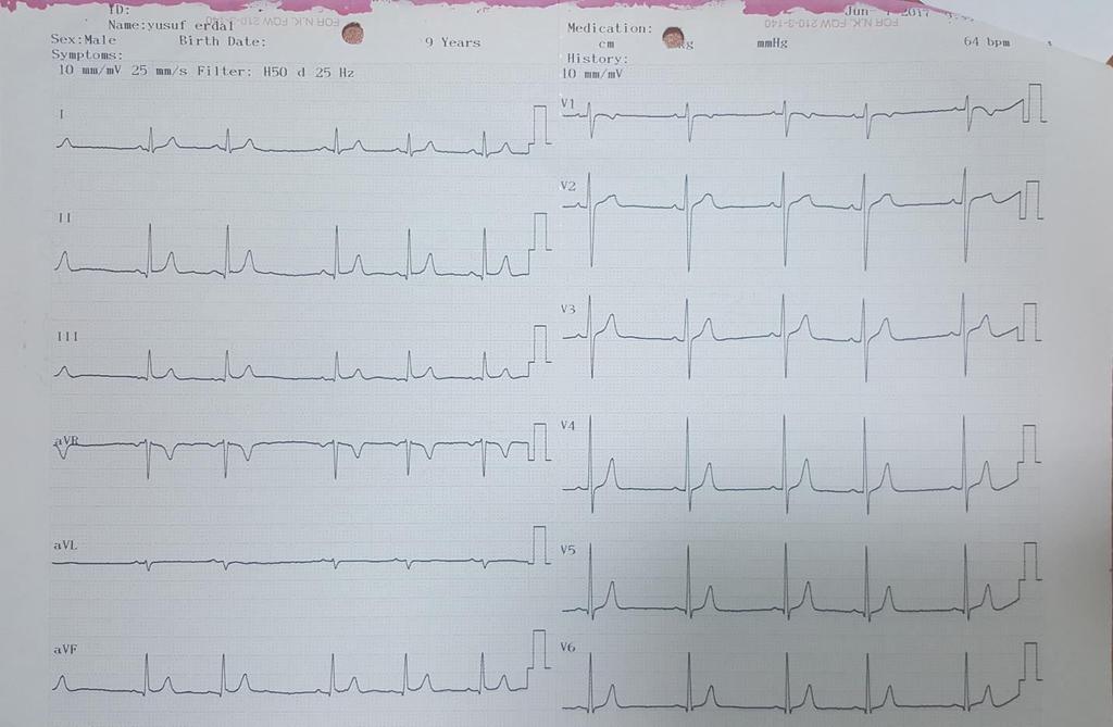 EKG