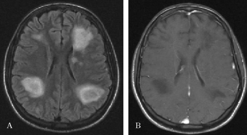 PML PML lezyonları MR da tipik olarak çok sayıda bilateral, asimetrik, kontrast tutmayan demyelinizan lezyonlar şeklinde kitle etkisi yok hemoraji yok