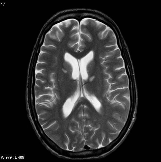 CMV CMV nörolojik hastalığı tanısı Klinik bulgular Görüntüleme PCR ile BOS ta ve beyin dokusunda CMV nin gösterilmesi (%80), sensitivite ve spesifite yüksek BOS ta