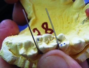 DiĢin mesial ve distal geniģliğinin tel uzunluğunu belirleyiniz DiĢin mesial ve distal