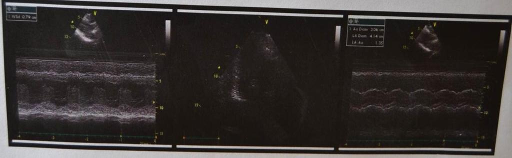 Çakır ve ark. Ç.Ü. Tıp Fakültesi Dergisi GİRİŞ Kalp tümörleri nadir görülen, malign formlarda prognoz kötü fakat bening formlarında cerrahi tedavi ile yüksek başarı sağlanan hastalıklardır 1.