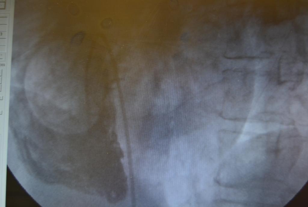 Cilt 37 Yıl 2012 Mitral Kapak Anterior Resim 2. TARTIŞMA Miksoma en fazla görülen bening kalp tümörüdür ve tüm primer kalp tümörlerinin yaklaşık % 30 unu oluşturmaktadır 5.