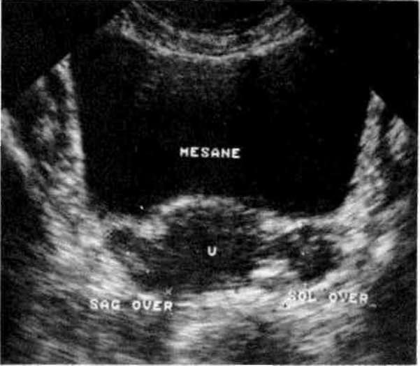 Günümüzde, ultrasonografi ile birlikte eskiden beri kullanılagelmekte olan testler de birlikte uygulanır.