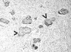 Mandibular sementifying fibroma Olgu Sunumu 22 yafl nda bayan hastan n, 6 ay önce bafllayan ve gittikçe büyüyen sa alt çenedeki flifllik flikayetine, son 2 ay içerisinde sa alt çenede bafllayan a r