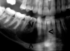 Yap lan AB inde yetersiz materyal gelmesi üzerine insizyonel biyopsi yap ld. Biyopsi sonucu sementifying fibroma olarak geldi (Resim 1).