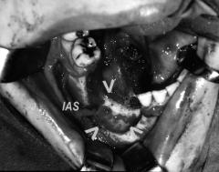 Mandibular sementifying fibroma Resim 5. Tümör eksize edildikten sonra oluflan defekt (oklar). IAS: inferior alveoler sinir. Resim 6. Defekt kansellöz kemik greft (KG) ile doldurulmufl.