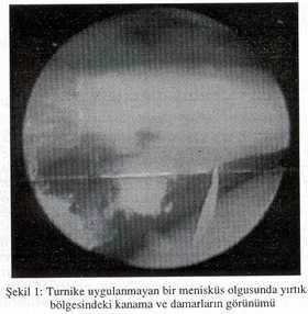 ve ya kapsülden 3 ve en fazla 5 mm uzaklığındaki yır tıklarda stabil dikişlerle tesbiti takiben oluşan infla matuar cevap ve vasküler proliferasyon yeterli sonu cu beraberinde getirmektedir (2, 3).