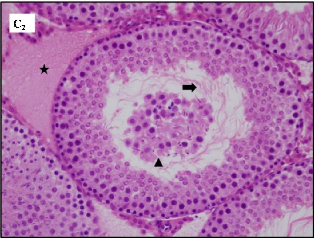 MTX+PS grubuna ait testis kesiti görüntüsü, lümende spermatoza yoğunluğu ( ) ve az sayıda lümende olgunlaşmamış germinal hücrelerin görüldüğü seminifer tübüller ( ) izlenmektedir (D1; H&E, X200,