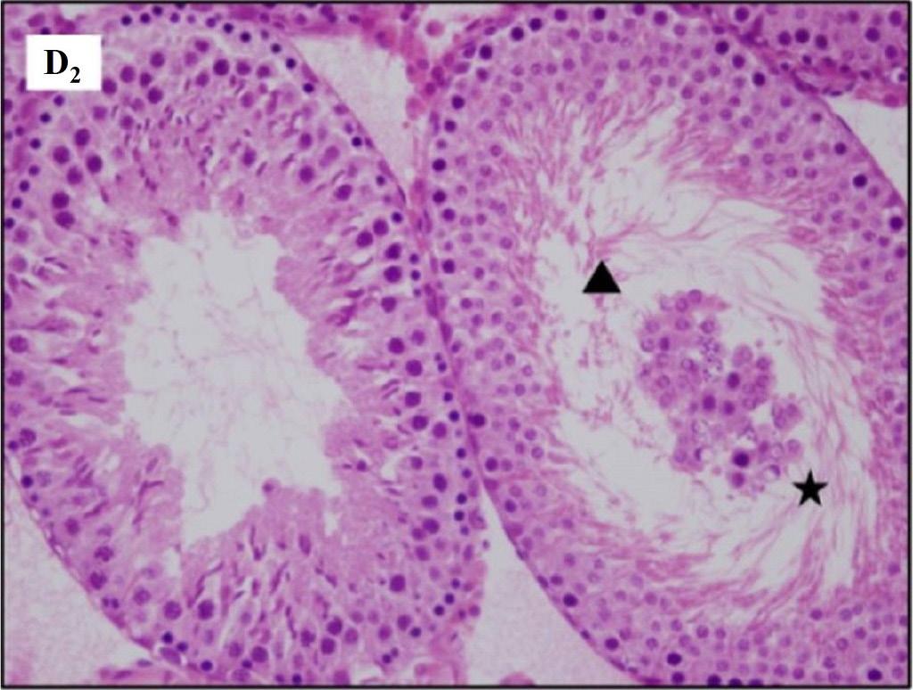 MTX grubuna ait testis kesit görüntüsünde, lümende olgunlaşmamış germinal epitel hücreleri ( ), seminifer tübül germinal epitelinde düzensizlikler ( )ve interstisyel alanda ödem ( ) izlenmektedir