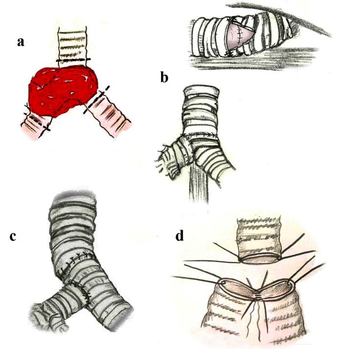 vantaj yaşamadık. Şekil 2. Karinal sleeve lobektomi için anastomoz seçenekleri a.karinal sleeve lobektomi için insizyon sınırları, b.