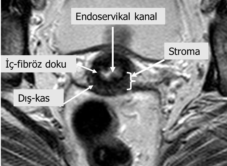 Dış myometriyum T2 ara sinyal intensitesindedir. Serviksin kastan oluşan dış stroması ile devam eder. şük intensiteli stromaya göre yüksek veya ara intensiteli alan olarak görülür.