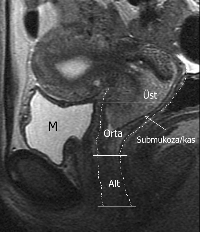 Vaginal kanser MRG de T2A görüntülerde ara, T1A görüntülerde düşük intensiteli olarak görülür[7] (Şekil 7).
