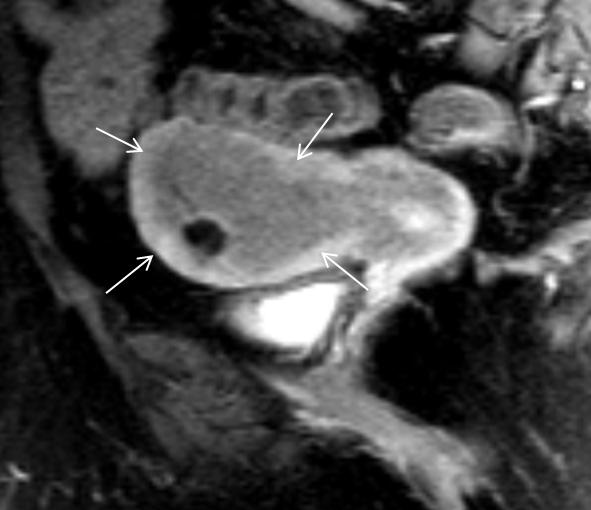 Dış myometriyum invaze görünümdedir (Evre IB). (b) İV kontrastlı sagital plan MRG de tümör alanı, myometriyuma göre daha az kontrast tutmaktadır (oklar).