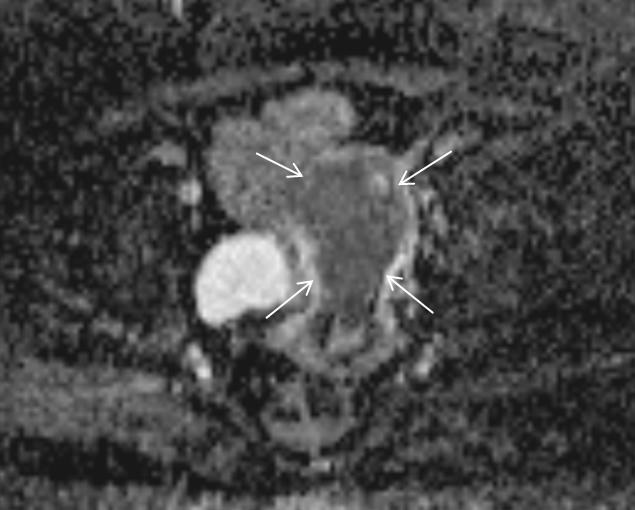İV kontrsatlı ve difüzyon MRG sekansları, myometriyal invazyon derinliğinin değerlendirilmesinde T2A görüntülerin doğruluğunu arttırır. relemesinde kullanılır.