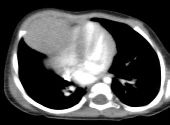 Direk grfide sol kciğer lt zond multikistik görünümde heterojen rdyolusensi görülmektedir. Trke ve medisten sğ kymıştır.